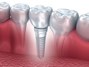 EXCEPTIONNEL : POSTE FORMATION IMPLANTOLOGIE H/F