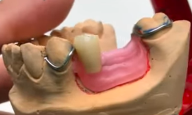 Prothésiste dentaire qualifié en prothèse adjointe