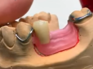Prothésiste dentaire qualifié en prothèse adjointe