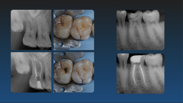 Collaboration en Endodontie Exclusive – Spécialiste Itinérant (Secteur Haute-Savoie / Chamonix)