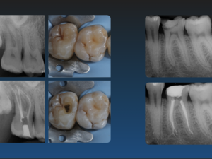 Collaboration en Endodontie Exclusive – Spécialiste Itinérant (Secteur Haute-Savoie / Chamonix)