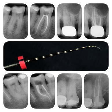 Collaboration en Endodontie Exclusive - Spécialiste Itinérant (Secteur Haute-Savoie / Chamonix)