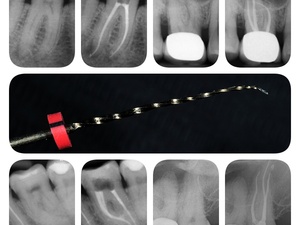 Collaboration en Endodontie Exclusive - Spécialiste Itinérant (Secteur Haute-Savoie / Chamonix)