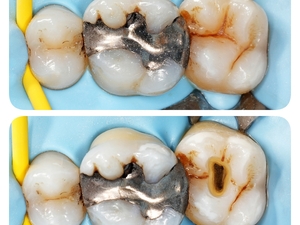Vacations en Endodontie Exclusive – Haute-Savoie (74)