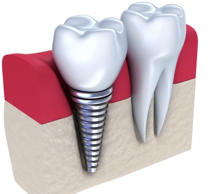 Poste en Chir / Implants / DDS H/F