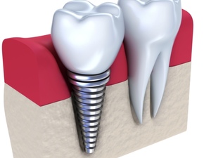 Poste en Chir / Implants / DDS H/F