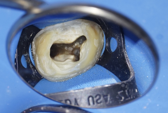 Collaboration libérale - Endodontiste / dentisterie adhésive & réhabilitation 