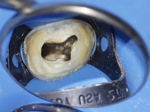 Collaboration libérale - Endodontiste / dentisterie adhésive & réhabilitation 