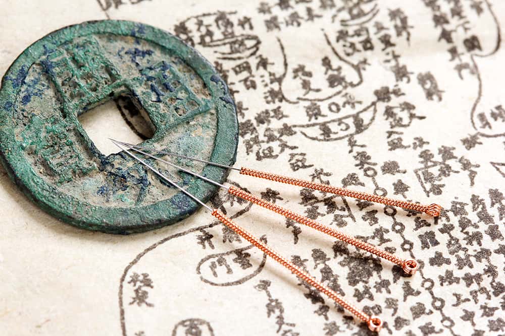 Acupuncture: tous ses bienfaits pour la santé