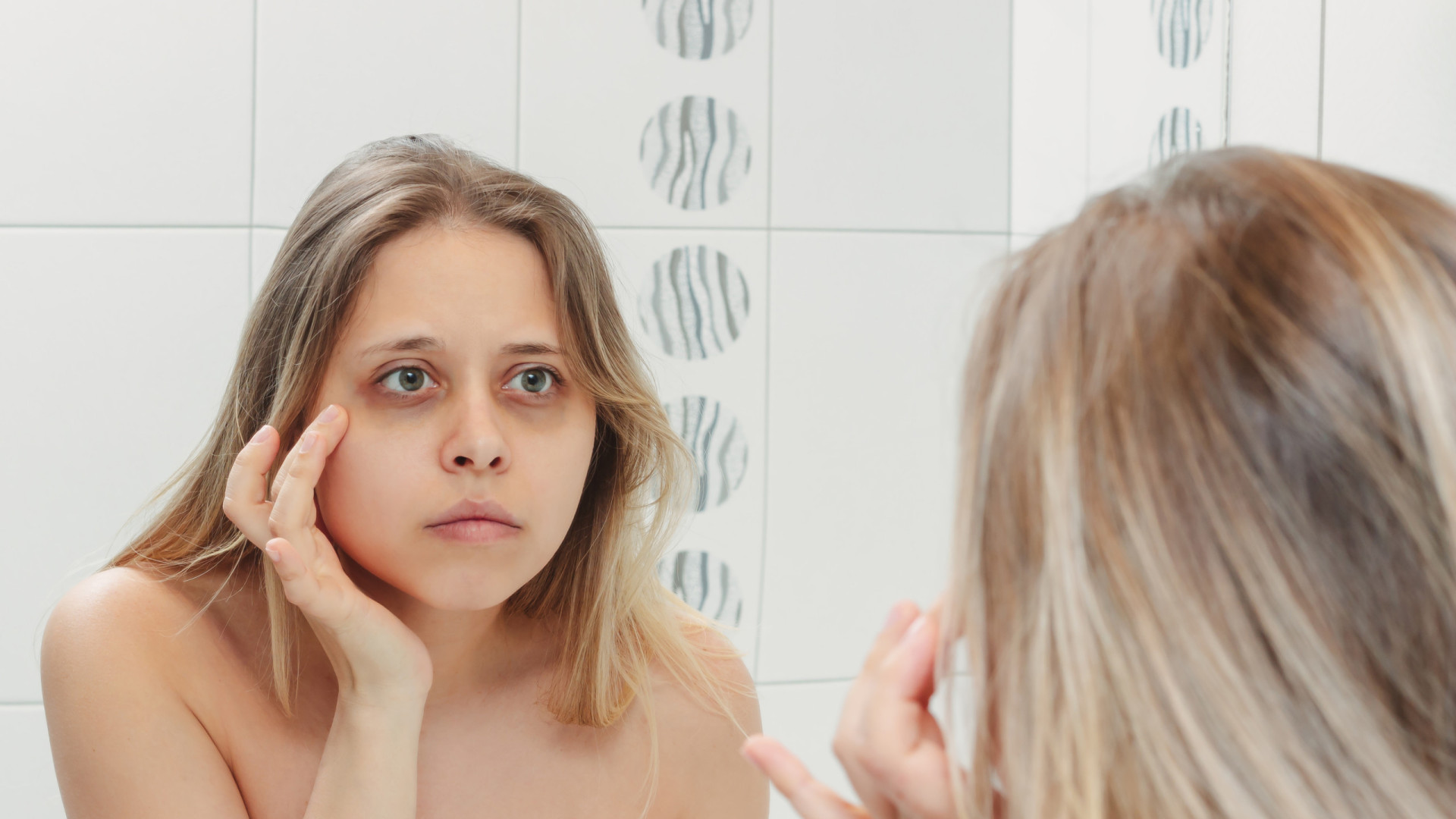 Soluções Naturais: Adeus às Olheiras de Forma Eficaz