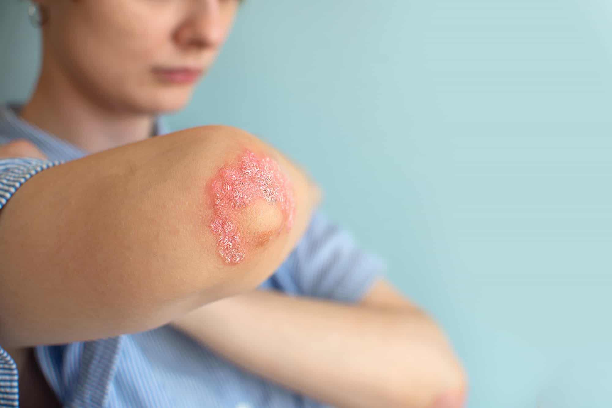Psoriasis en los niños: Causas, síntomas y tratamiento