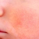 ¿Cómo sé si mi bebé tiene eczema?
