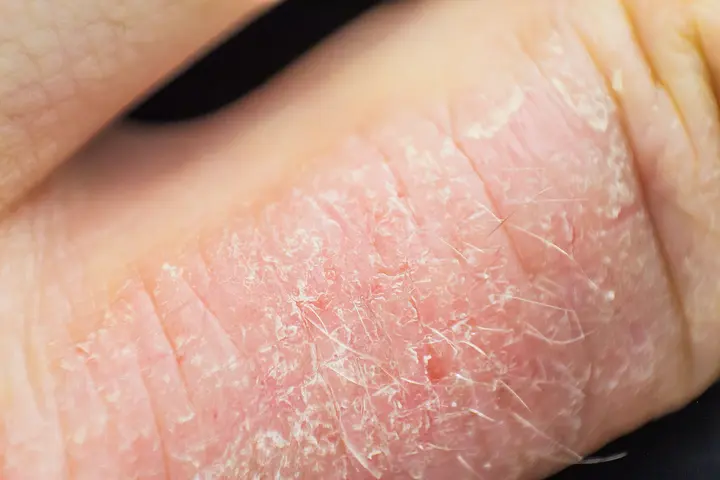 Eczéma