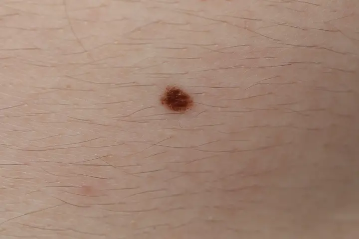 Grain de beauté