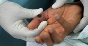 В Индии нашли новый штамм оспы обезьян