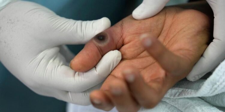 В Индии нашли новый штамм оспы обезьян