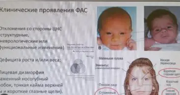 Что такое фетальный алкогольный синдром