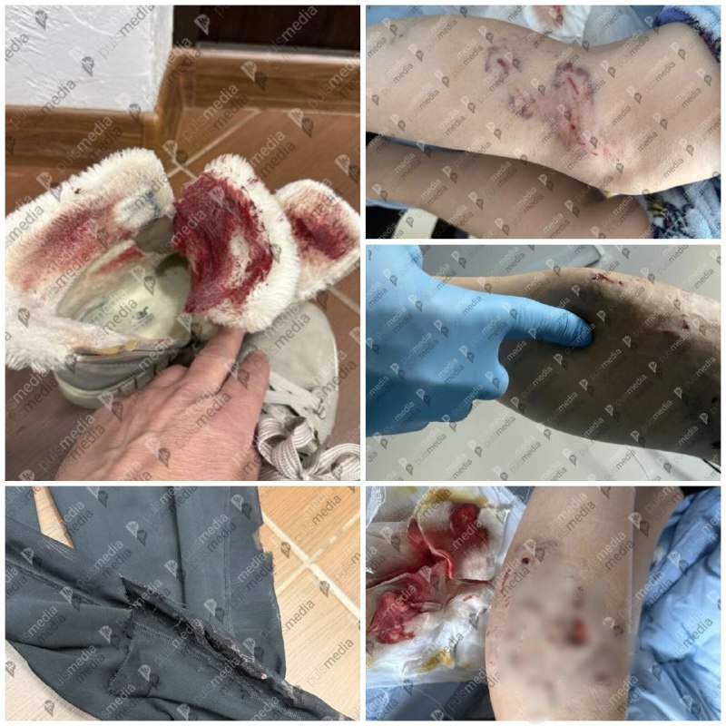 В Кишинёве стая собак напала на девушку, пострадавшая госпитализирована