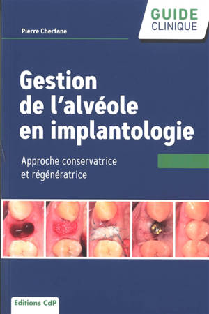 Gestion de l'alvéole en implantologie : approche conservatrice et régénératrice