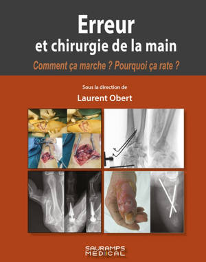 Erreur et chirurgie de la main : comment ça marche ? Pourquoi ça rate ?