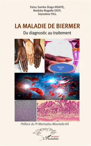 La maladie de Biermer : du diagnostic au traitement