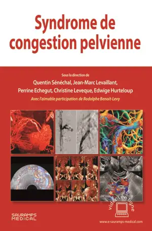 Syndrome de congestion pelvienne