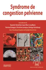 Syndrome de congestion pelvienne