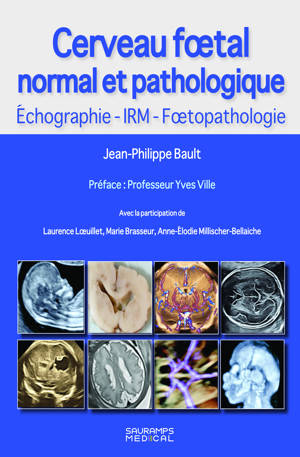 Cerveau foetal normal et pathologique -Echographie, IRM, Foetopathologie