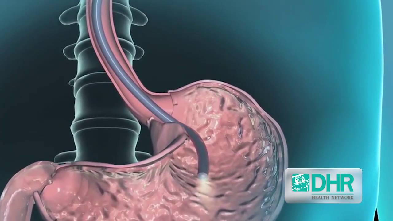 ¿Cómo te sientes después de una colonoscopia?