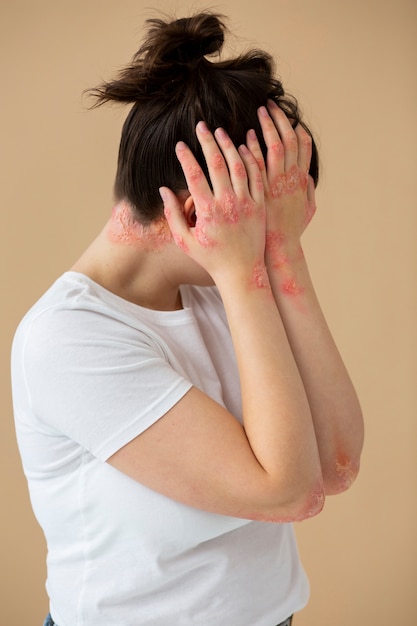 Las consecuencias del herpes sin tratamiento 6 Las consecuencias del herpes sin tratamiento