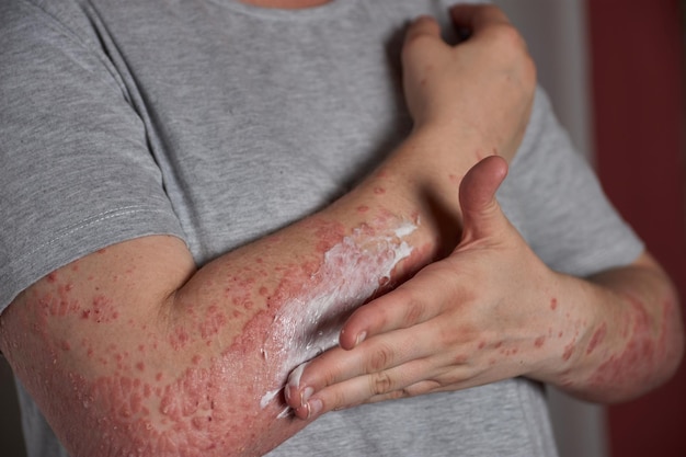 Las consecuencias del herpes sin tratamiento 7 Las consecuencias del herpes sin tratamiento