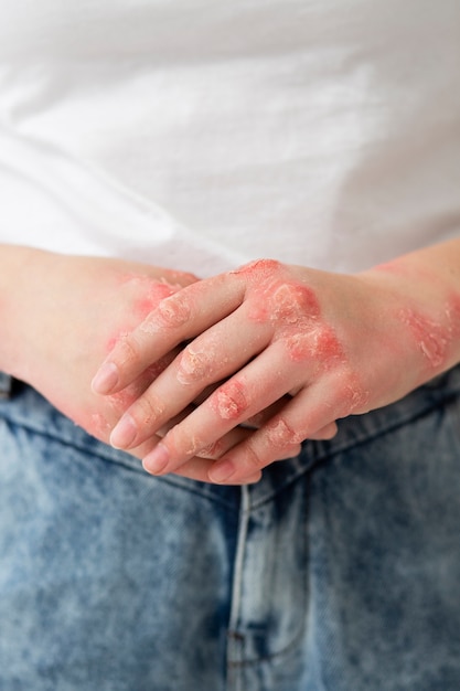 Las consecuencias del herpes sin tratamiento 8 Las consecuencias del herpes sin tratamiento