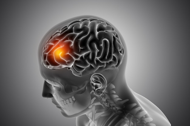 Consecuencias del daño cerebral y sus impactos 6 Consecuencias del daño cerebral y sus impactos