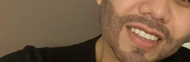 شاهد صور عمر كمال بعد خضوعه لعملية زراعة شعر الذقن
